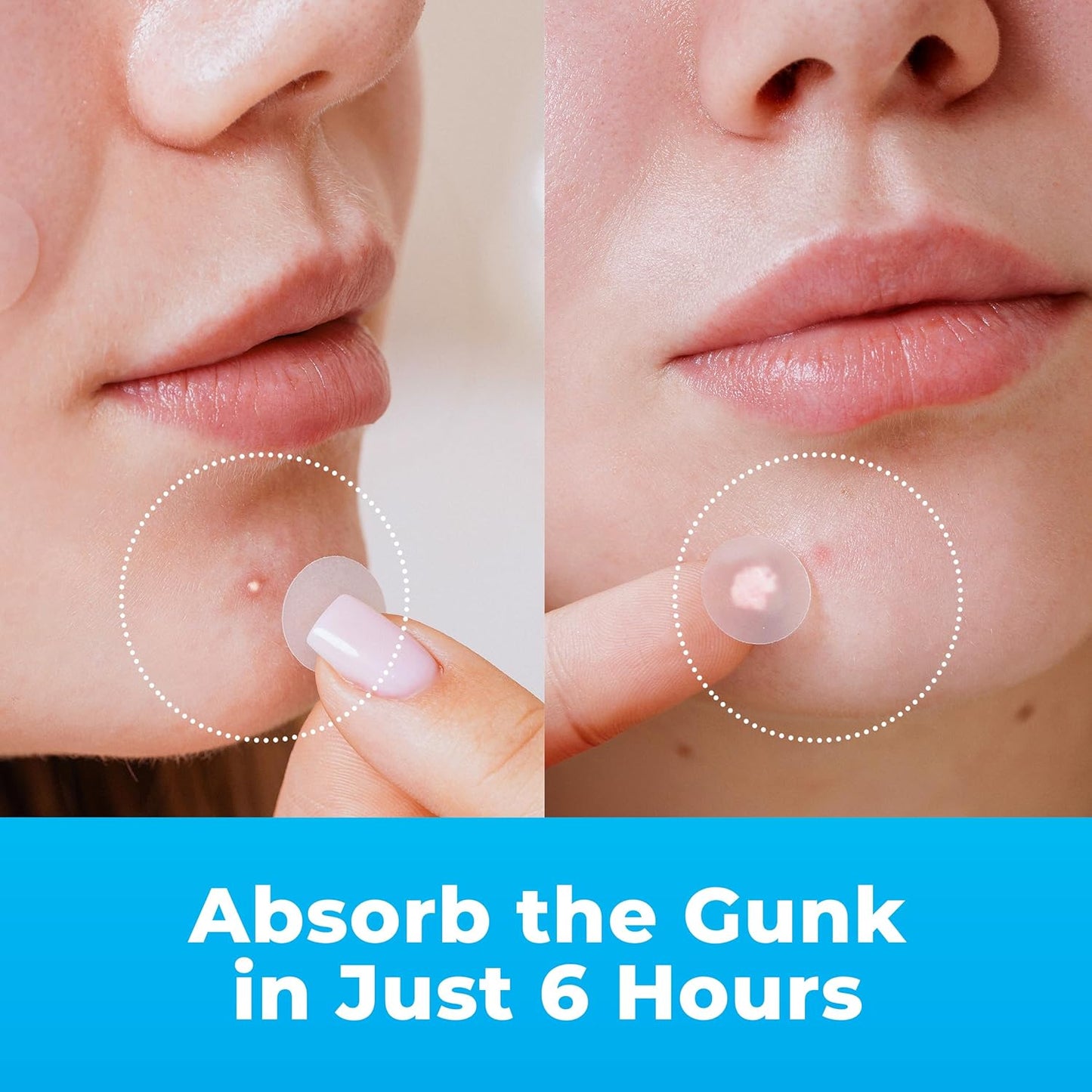 Hydrocolloid Pimple Patches for Face – Acne Spot Stickers with Tea Tree Oil (500 Patches)