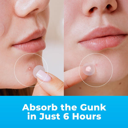 Hydrocolloid Pimple Patches for Face – Acne Spot Stickers with Tea Tree Oil (500 Patches)